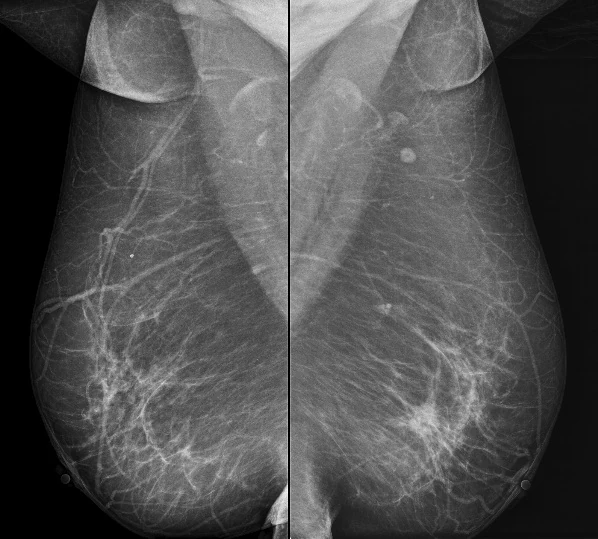 Radiologische Befundvorlagen · Digitale Mammographie · Mammografie